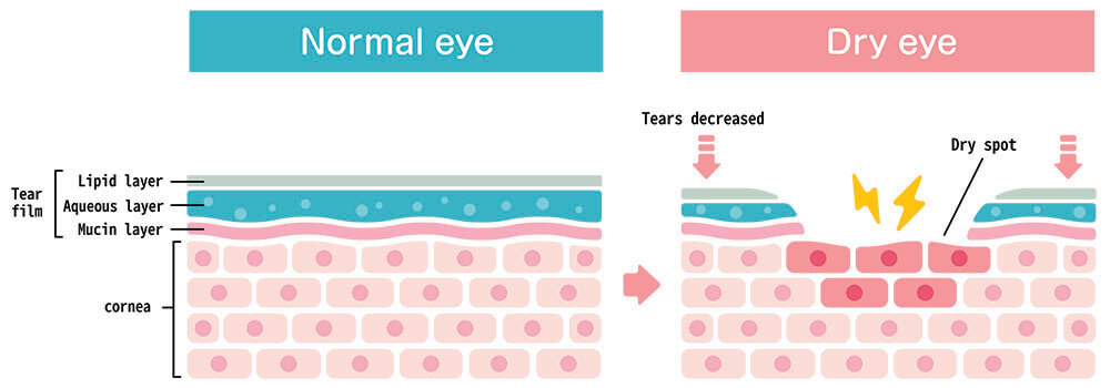 Chart Illustrating How Dry Eye Affects an Eye